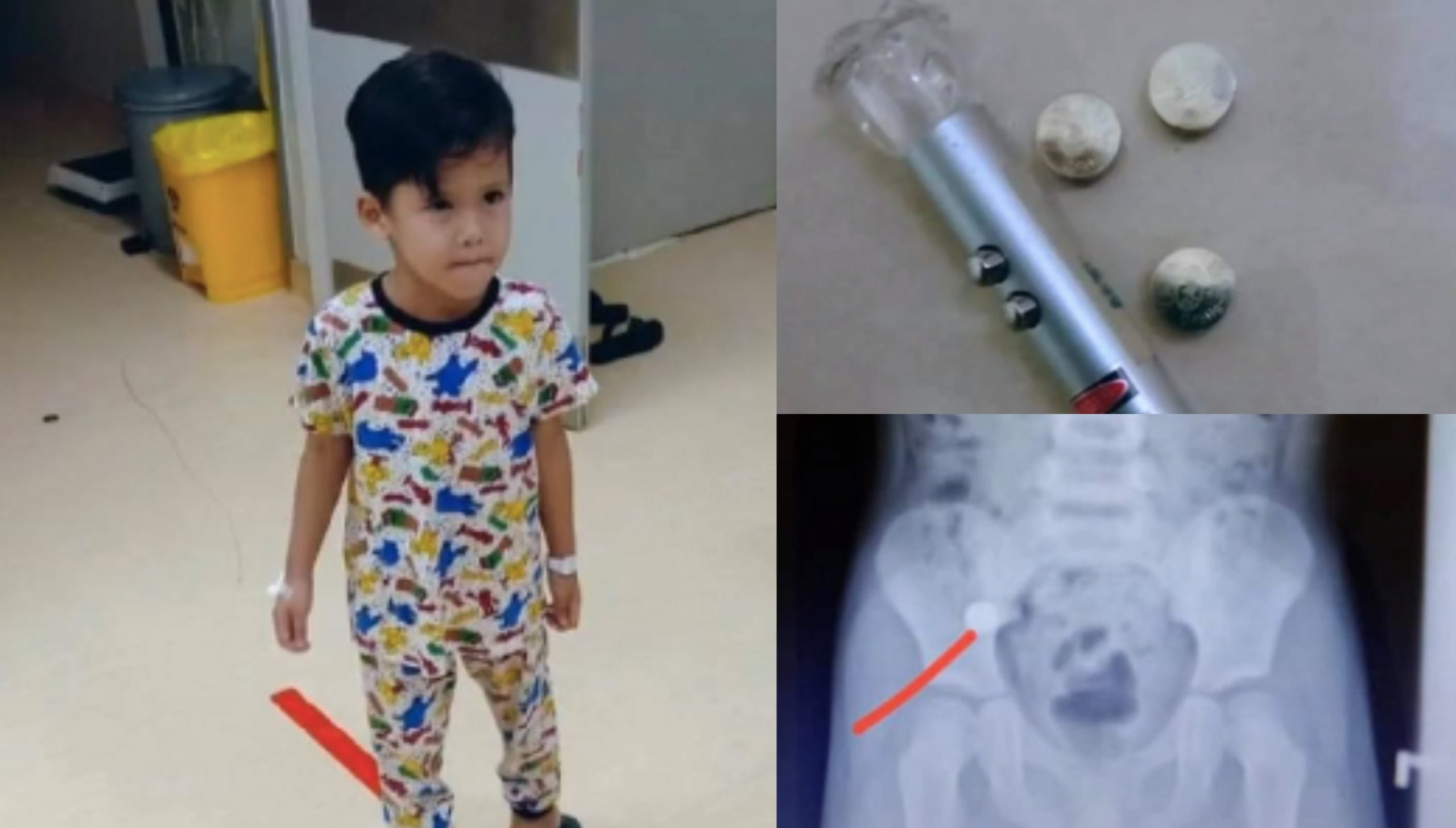 [VIDEO] Ibu Cemas Anak Telan 6 Biji Bateri Laser, Setiap Hari Kena X-ray Nak Pastikan Bateri ‘Keluar’