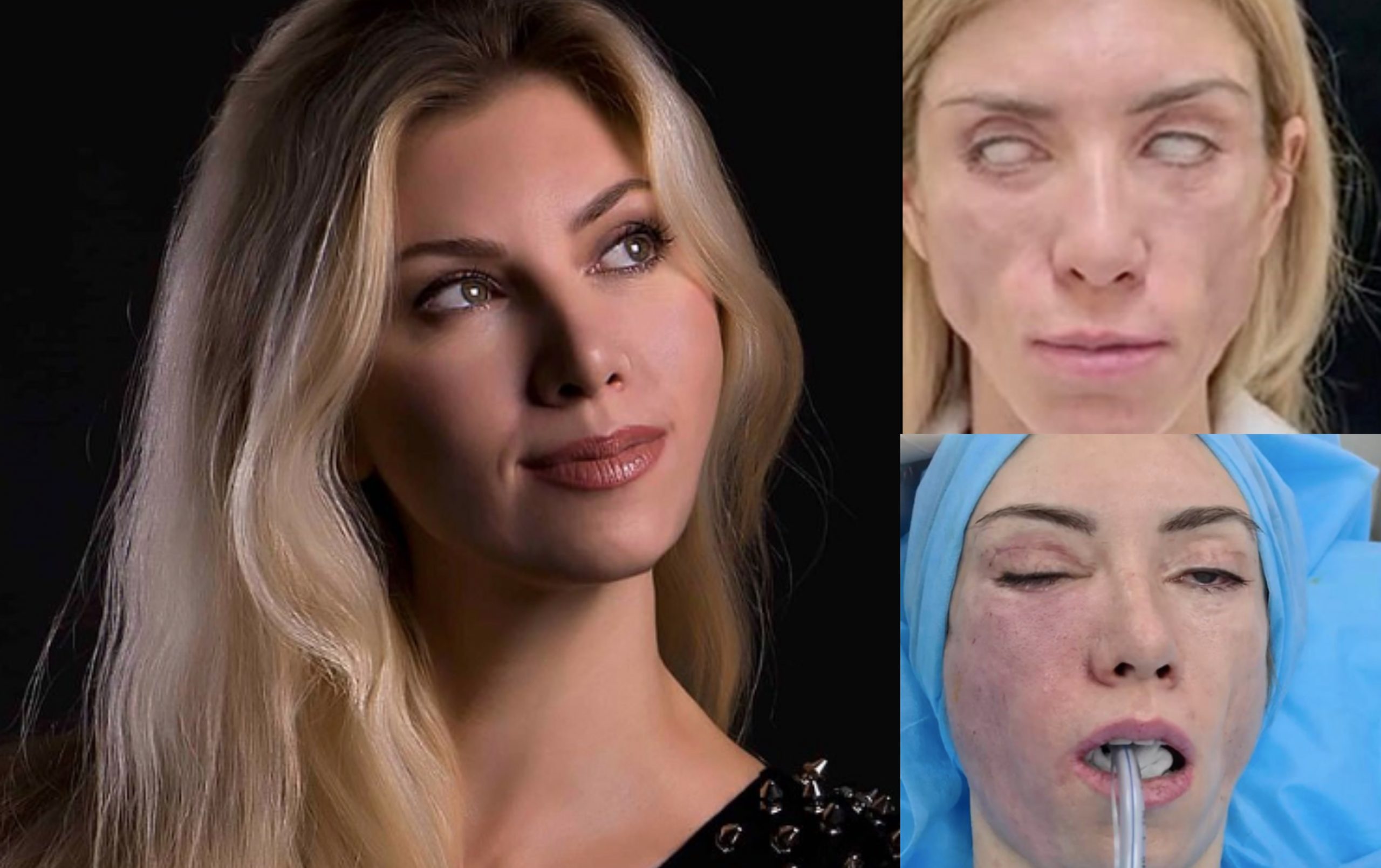 Pembedahan Plastik Gagal, Ratu Cantik Rusia Reda Mata Tak Boleh Tutup & Senyum